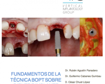 Nuevo curso «Fundamentos de la técnica BOPT sobre diente e implante»
