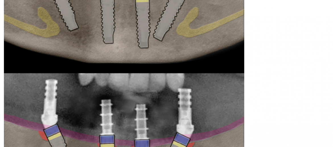Caso clínico: All-on-four con implantes PRAMA